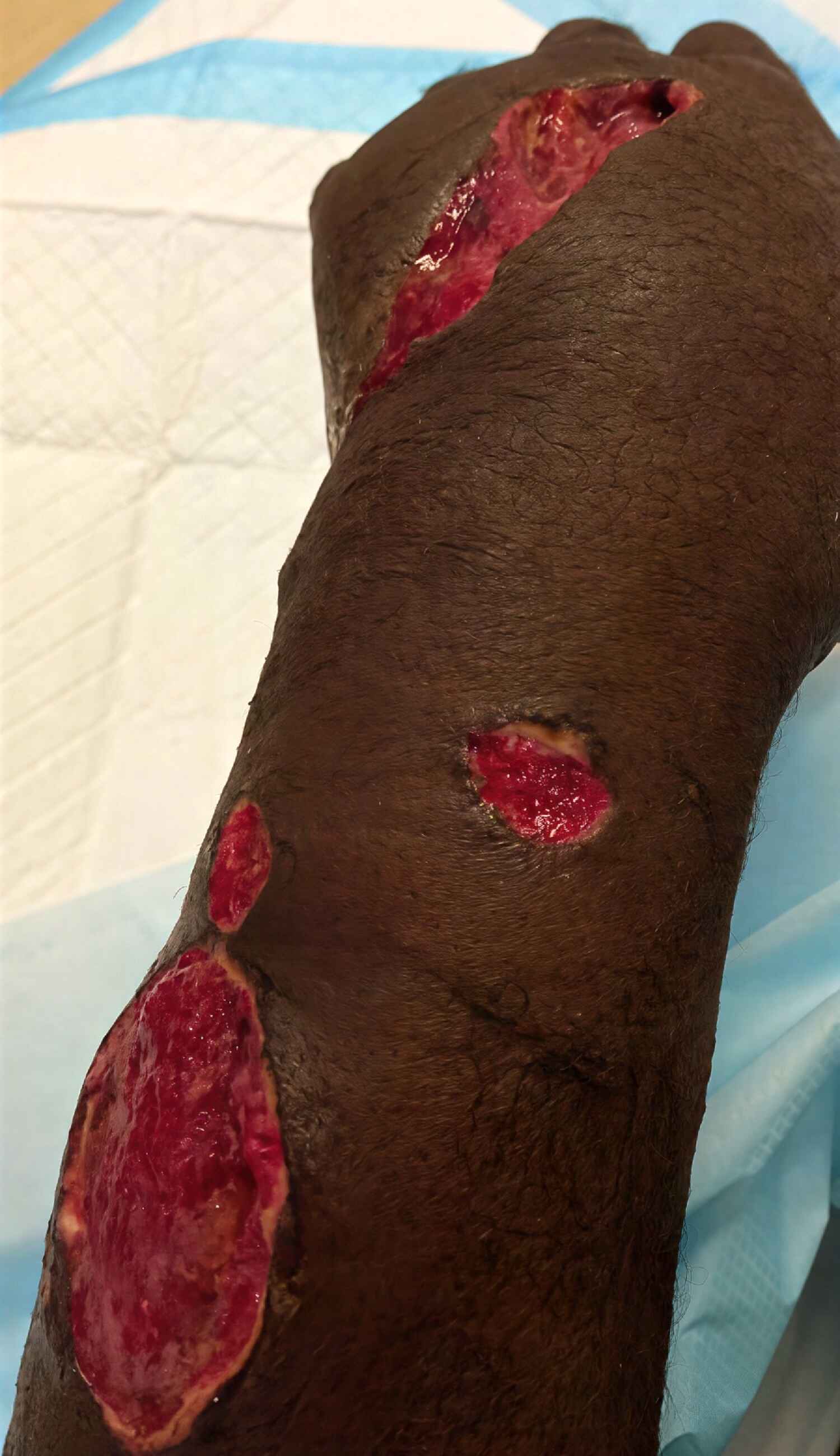 Close-up image of the wounds on Johannes' arm'.